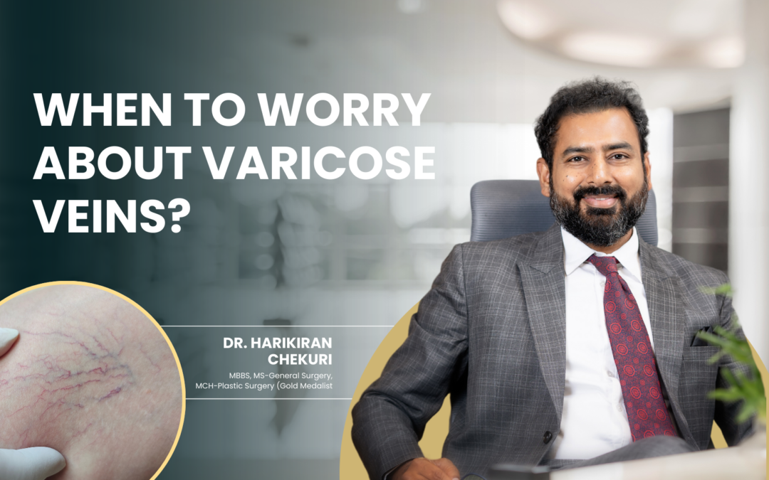 When to Worry About Varicose Veins?