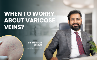 When to Worry About Varicose Veins?