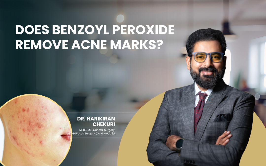 Does Benzoyl Peroxide Remove Acne Marks?