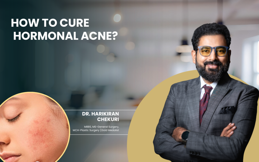How to Cure Hormonal Acne?