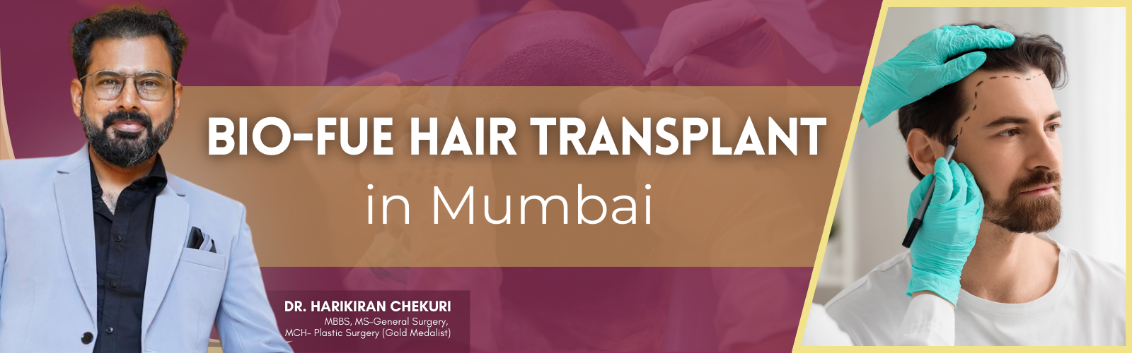 Bio-FUE Hair Transplant in Mumbai 