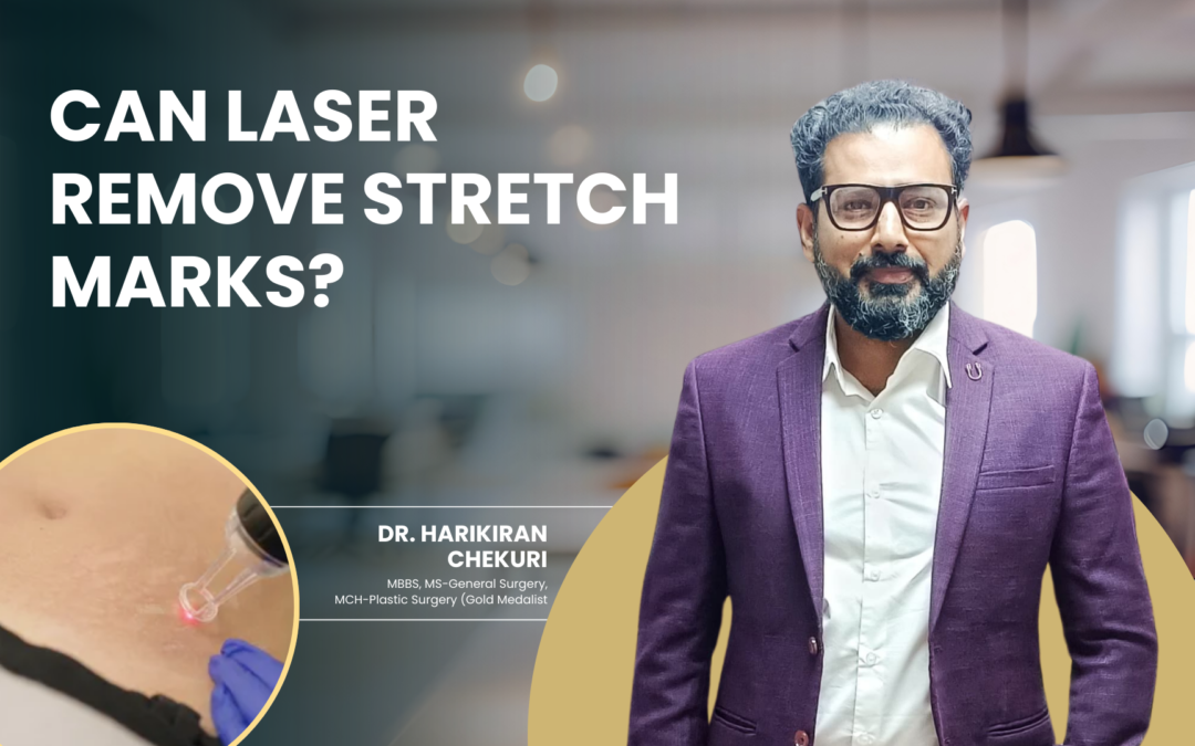 Can Laser Remove Stretch Marks?