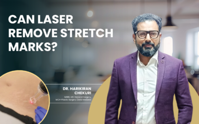 Can Laser Remove Stretch Marks?
