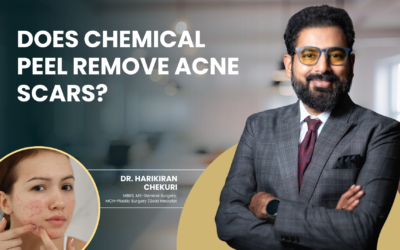 Does Chemical Peel Remove Acne Scars?