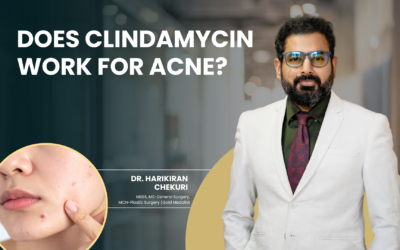 Does Clindamycin Work for Acne?