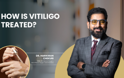 How Is Vitiligo Treated?