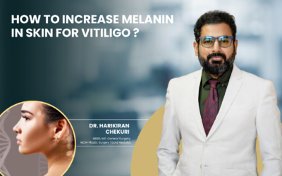 How to Increase Melanin in Skin for Vitiligo?