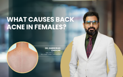 What Causes Back Acne in Females?