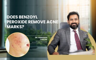Does Benzoyl Peroxide Remove Acne Marks?