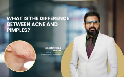 What Is the Difference Between Acne and Pimples?