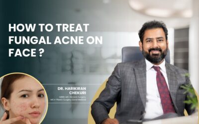How to Treat Fungal Acne on Face?