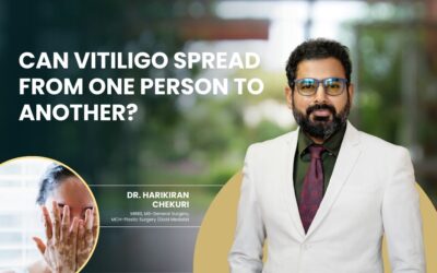 Can Vitiligo Spread From One Person to Another?