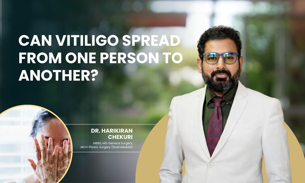 Can Vitiligo Spread From One Person to Another?