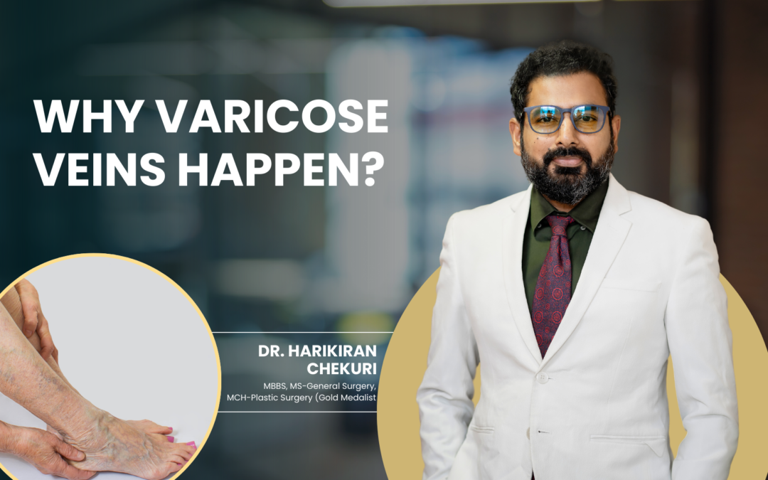 Why Varicose Veins Happen?