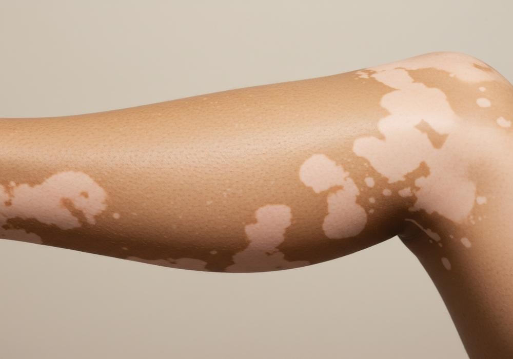 vitiligo4 | Redefine