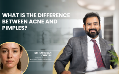 What Is the Difference Between Acne and Pimples?