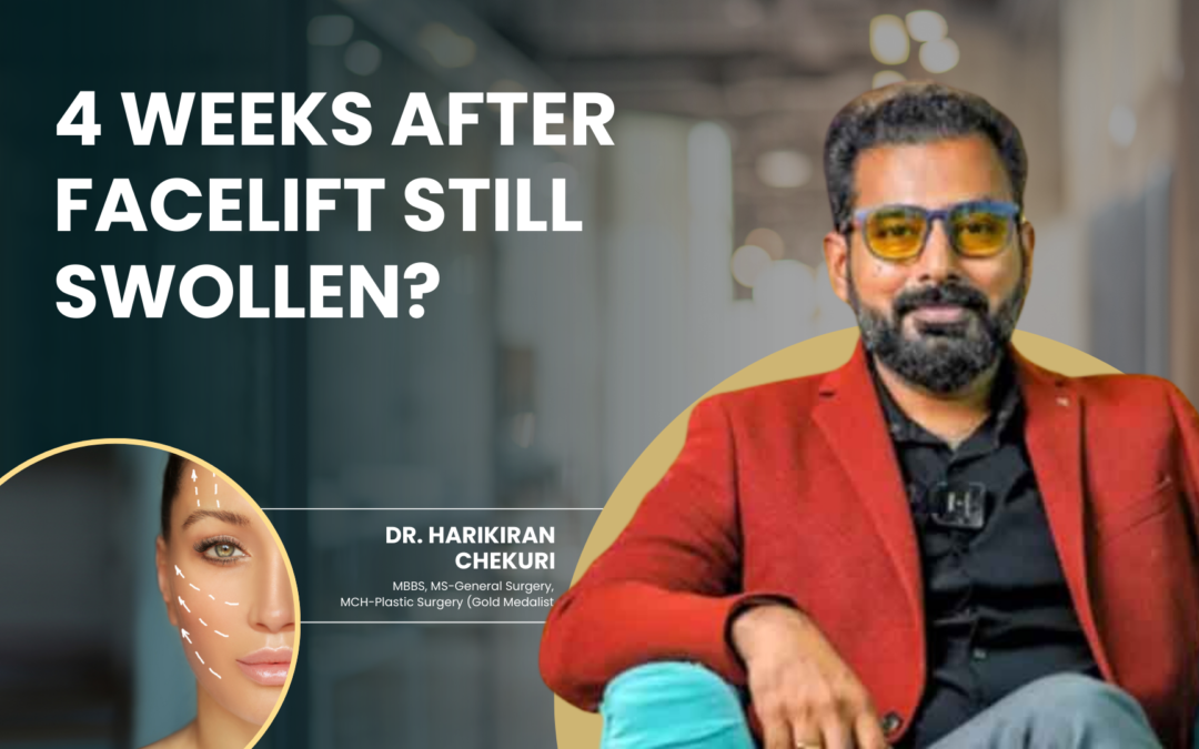 4 Weeks After Facelift Still Swollen?