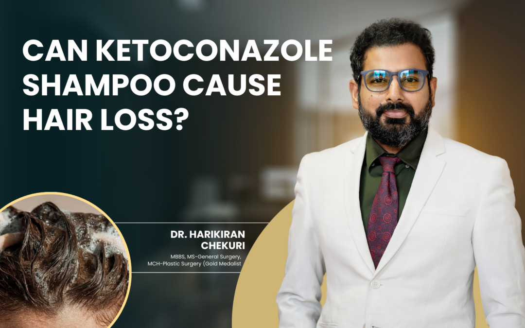 Can Ketoconazole Shampoo Cause Hair Loss?