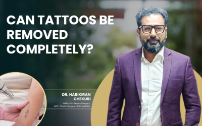 Can Tattoos Be Removed Completely?