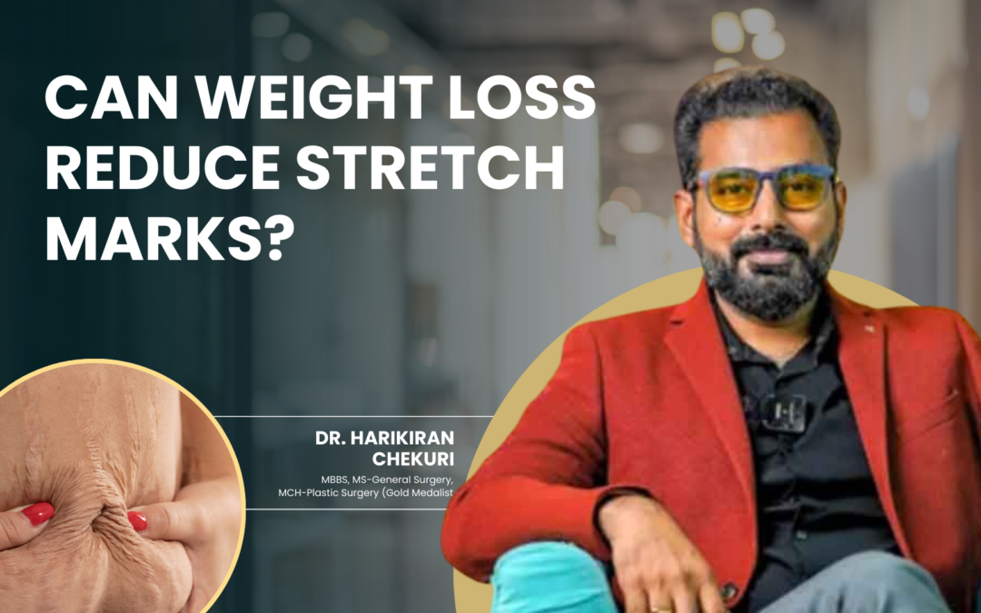 Can Weight Loss Reduce Stretch Marks?