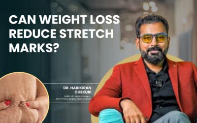 Can Weight Loss Reduce Stretch Marks?