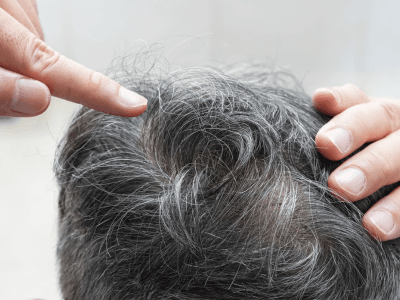 Causes of Hair Loss | Redefine