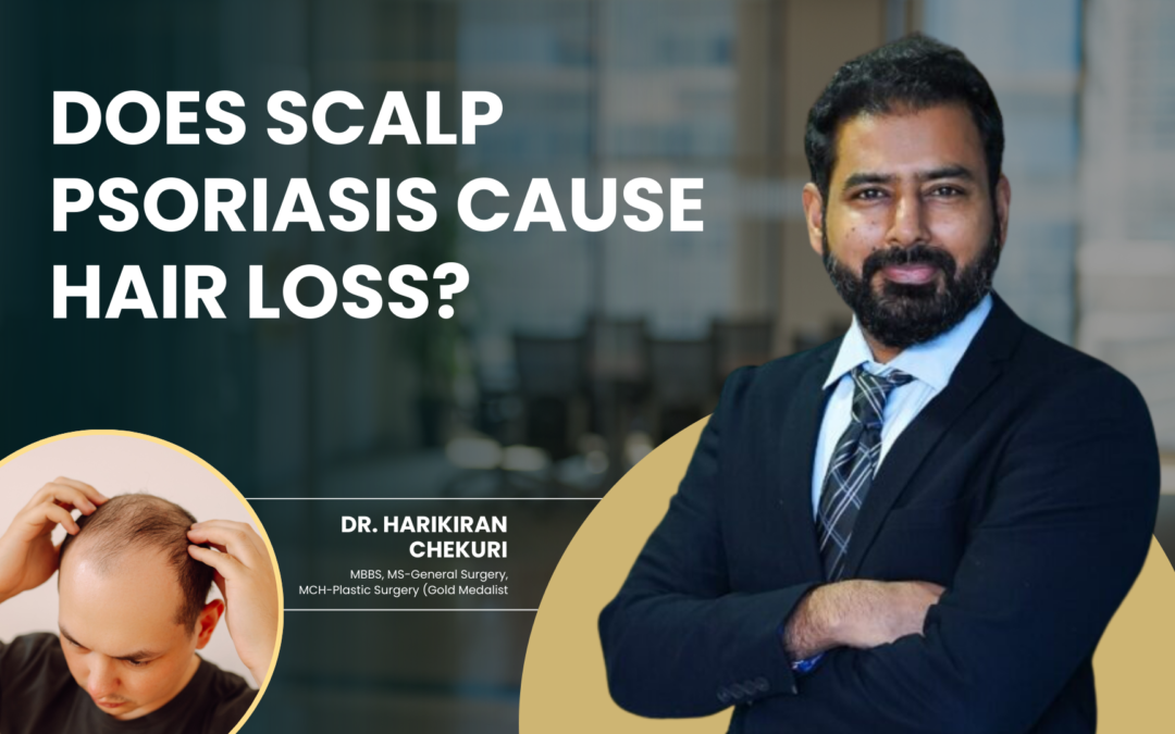 Does Scalp Psoriasis Cause Hair Loss?