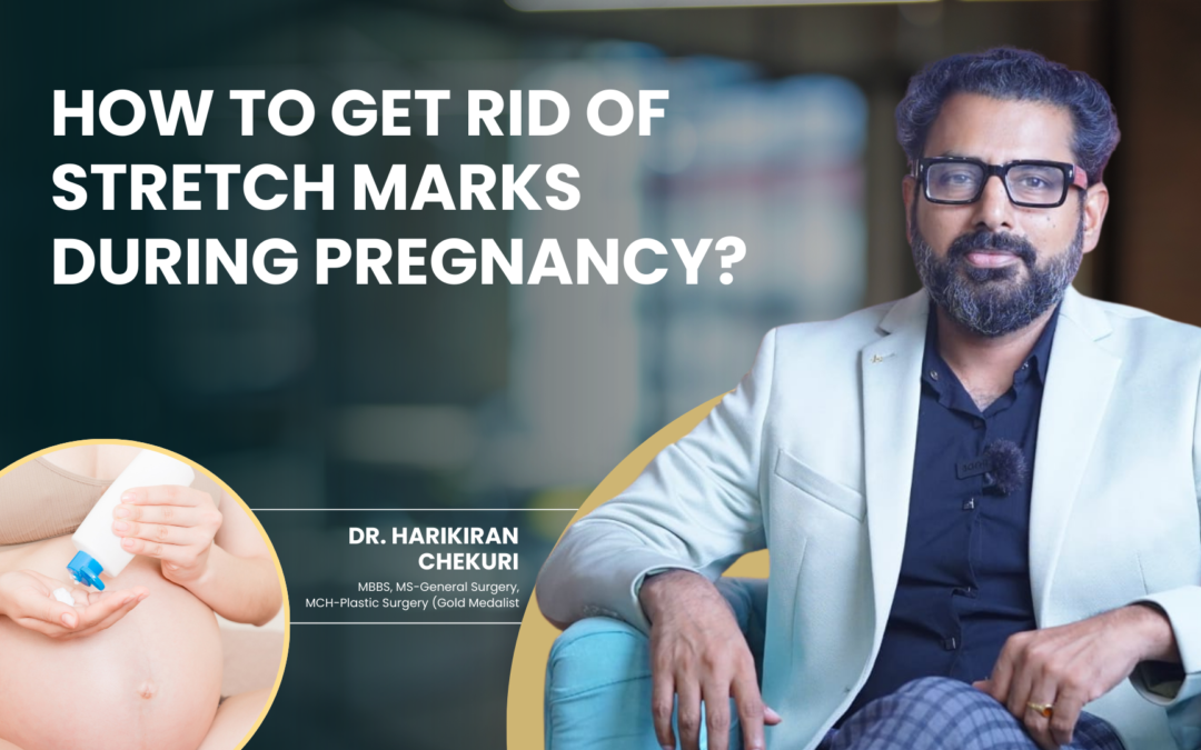 How to Get Rid of Stretch Marks During Pregnancy?