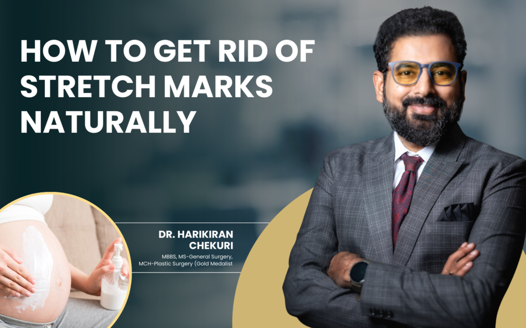 How to Get Rid of Stretch Marks Naturally