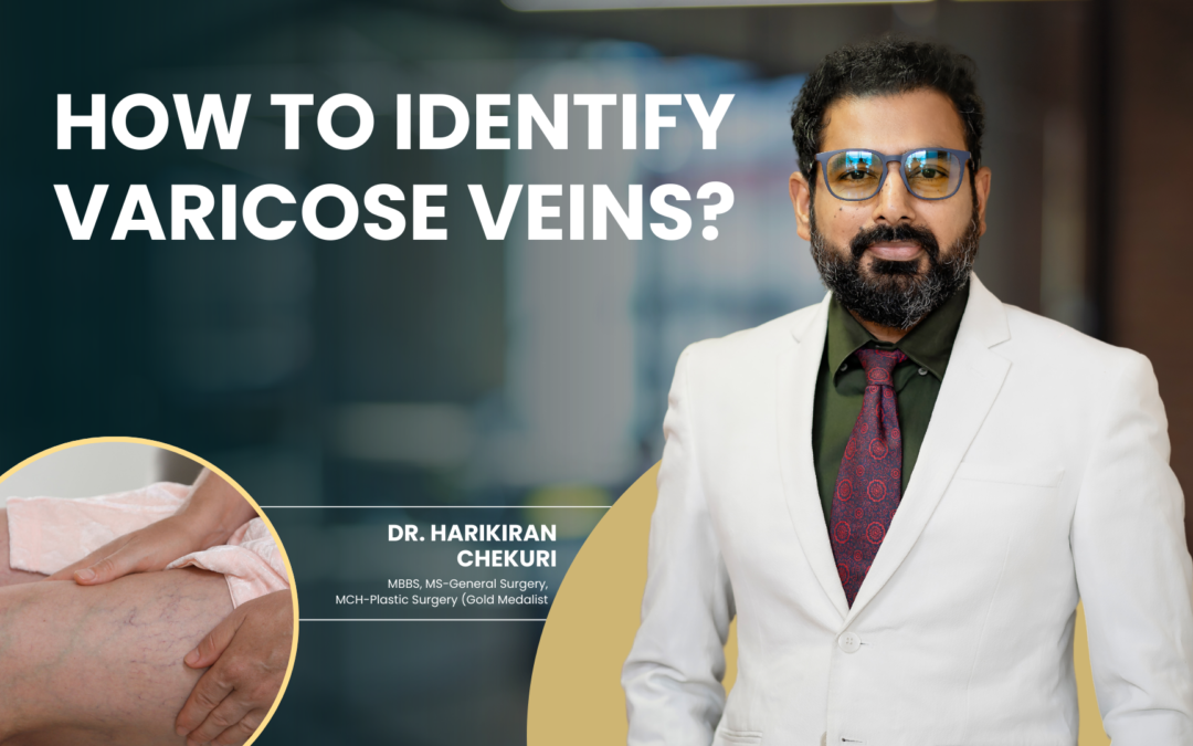 How to Identify Varicose Veins?