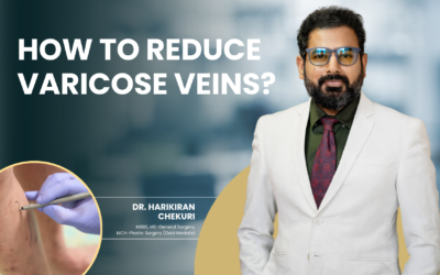 How to Reduce Varicose Veins?
