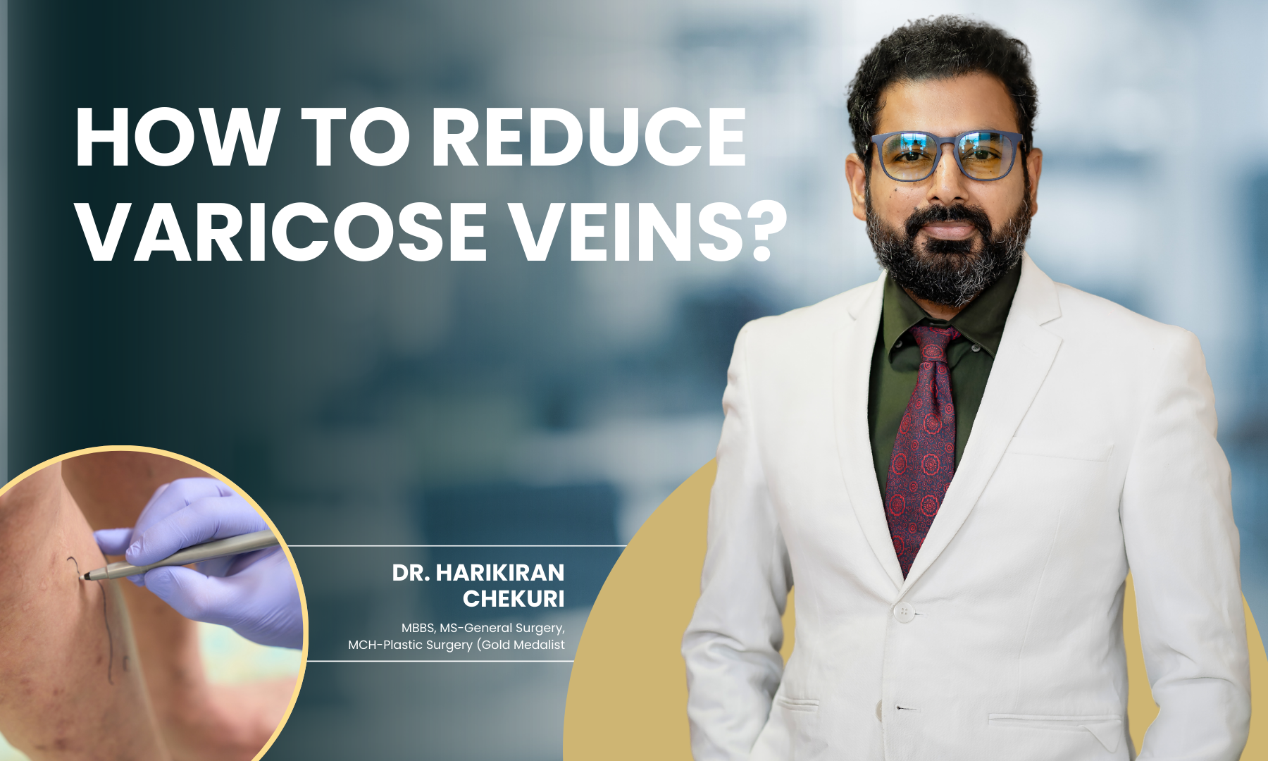 How to Reduce Varicose Veins | Redefine