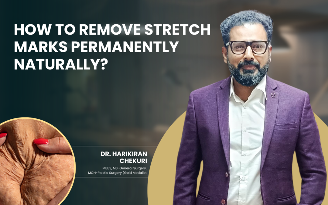 How to Remove Stretch Marks Permanently Naturally?