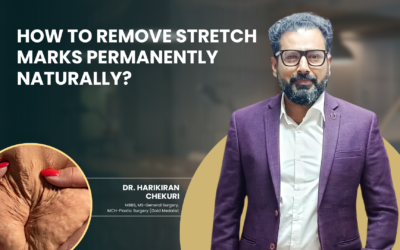 How to Remove Stretch Marks Permanently Naturally?