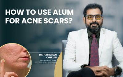 How to Use Alum for Acne Scars?