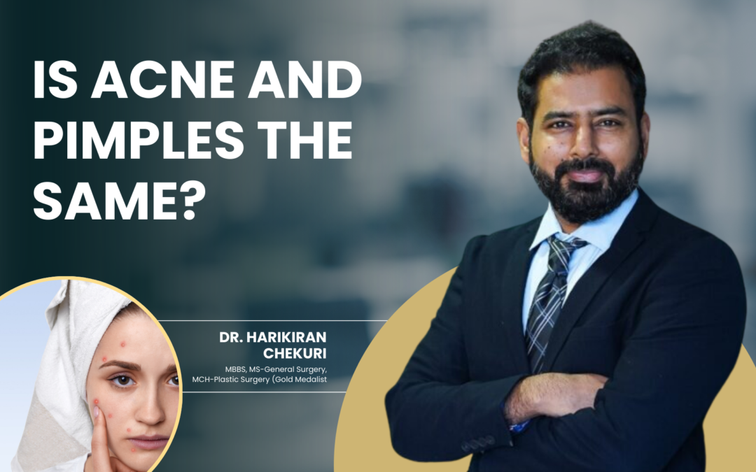 Is Acne and Pimples the Same?