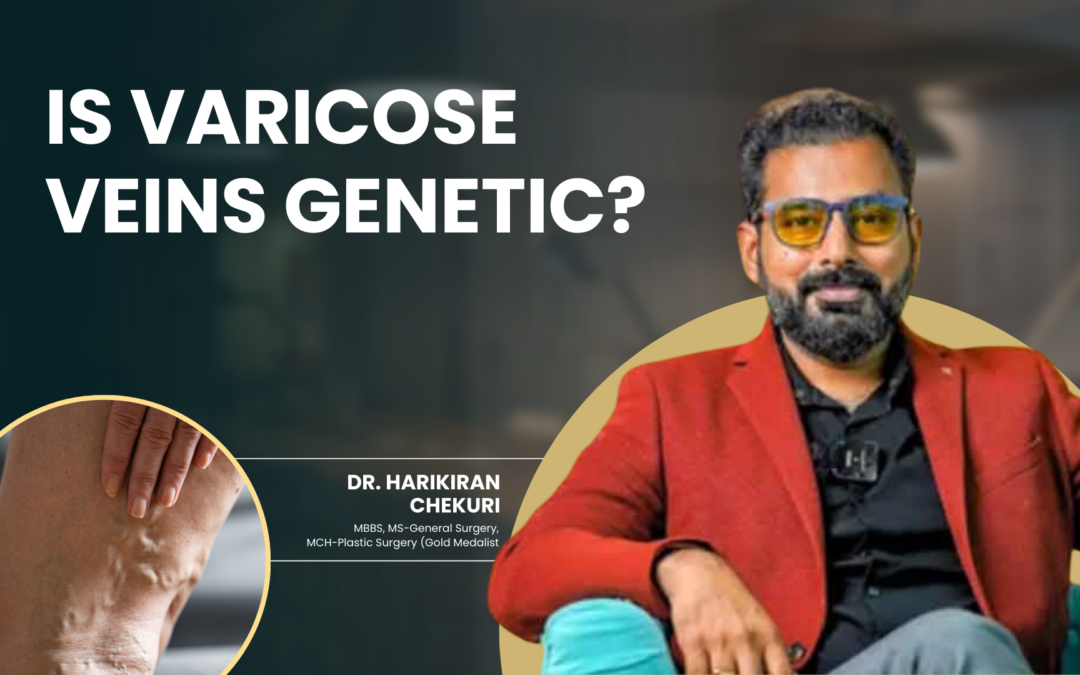 Is Varicose Veins Genetic