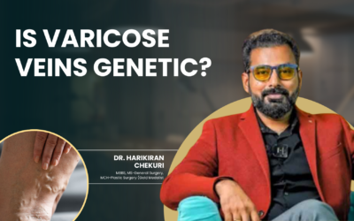 Is Varicose Veins Genetic