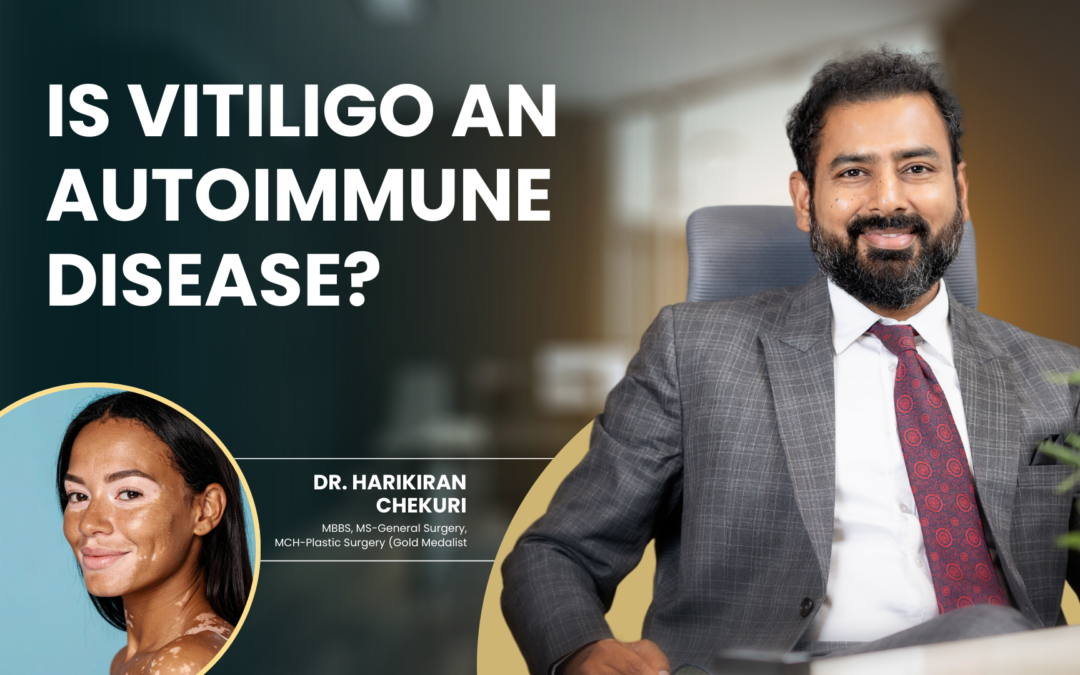 Is Vitiligo an Autoimmune Disease?