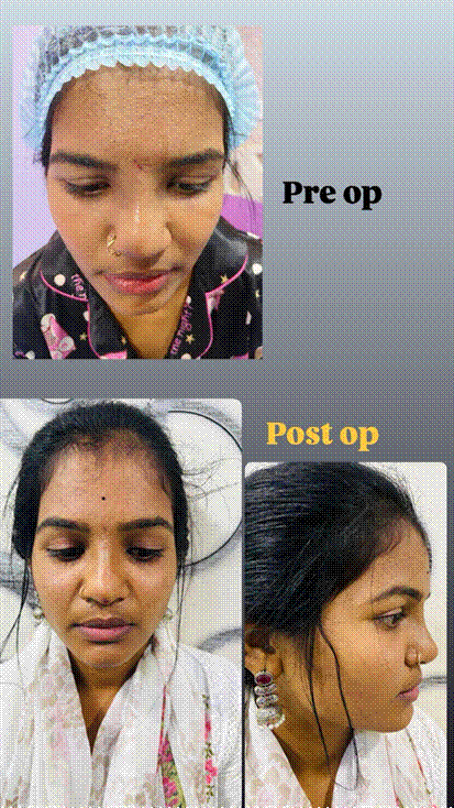 rhinoplastyp1 | Redefine