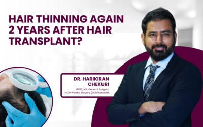 Hair Thinning Again 2 Years After Hair Transplant?