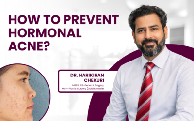 How to Prevent Hormonal Acne?