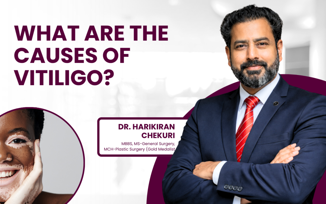 What Are the Causes of Vitiligo?