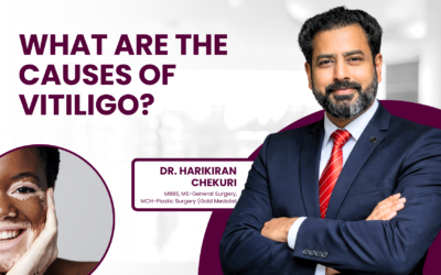 What Are the Causes of Vitiligo?