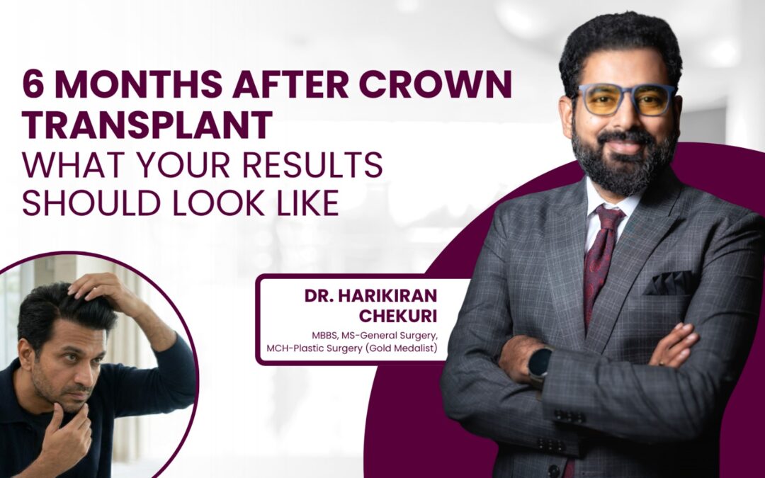 Crown Hair Transplant After 6 Months