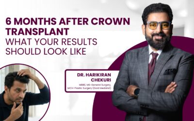 Crown Hair Transplant After 6 Months