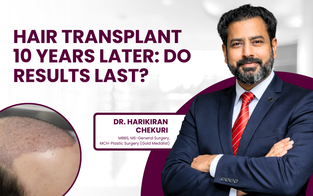 Hair Transplant 10 Years Later: Do Results Last?