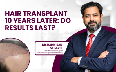 Hair Transplant 10 Years Later: Do Results Last?