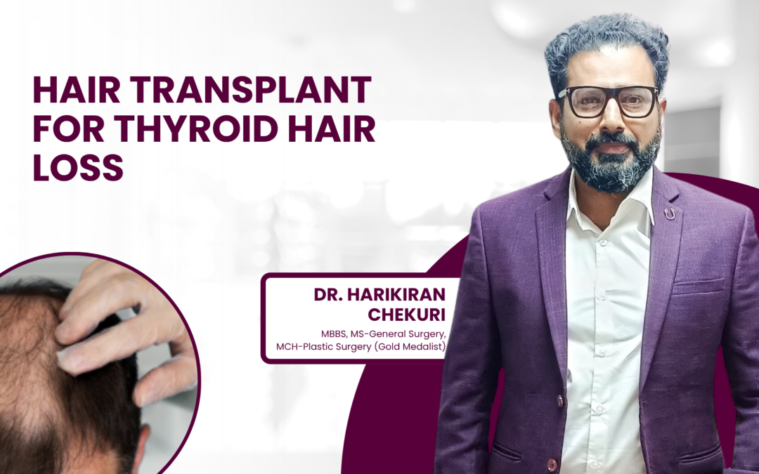 Hair Transplant for Thyroid Hair Loss