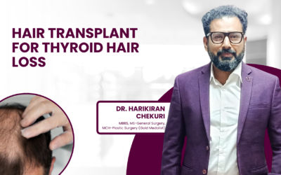 Hair Transplant for Thyroid Hair Loss